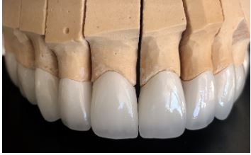 Zirconium Crowns and Veneers in Turkey