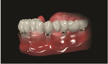 All On 6 Dental Implant in Turkey