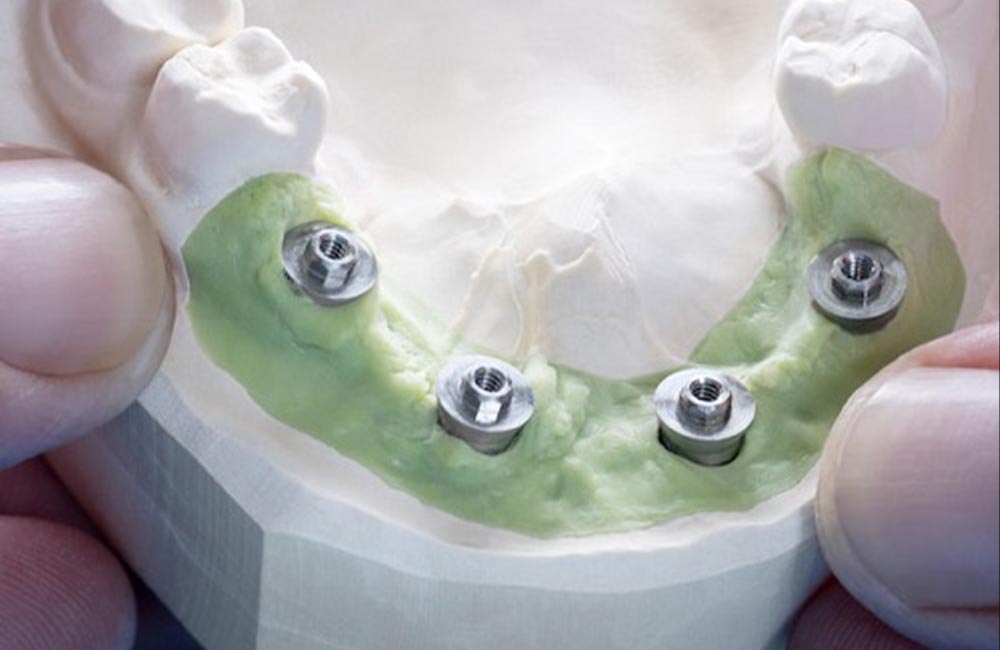 All on Four Dental Implants in Turkey