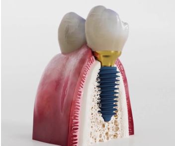 What is dental implant